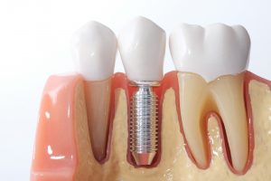 Model of a dental implant placed by a dental team with a new replacement tooth cemented.